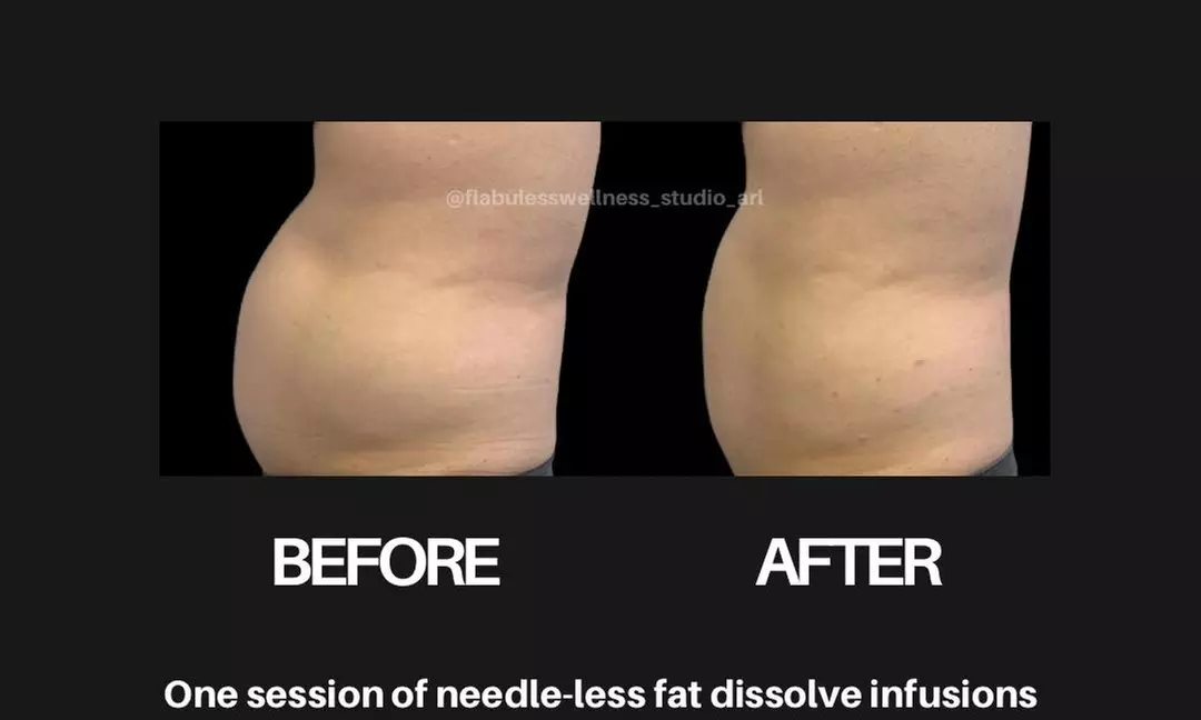 Up to 51% Off on Needle-Free Fat Dissolve Infusion