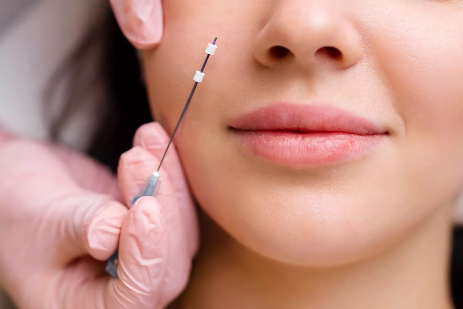 Up to 33% Off on FORTY (40) mini PDO Thread lift for Jawline/Double Chin/Neck at Victoria Med Spa - Primary Image