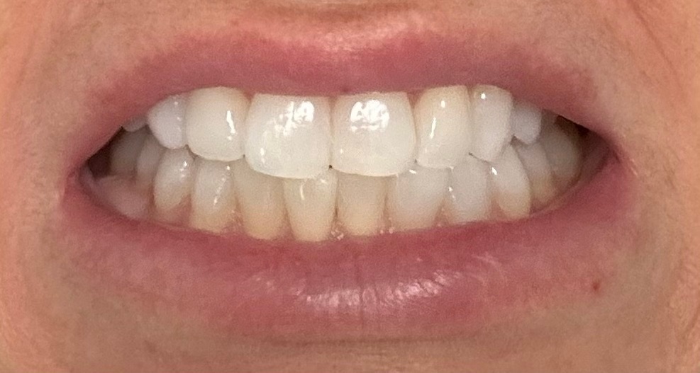 Up to 55% Off on Teeth Whitening - In-Office - Non-Branded at Bright Smiles