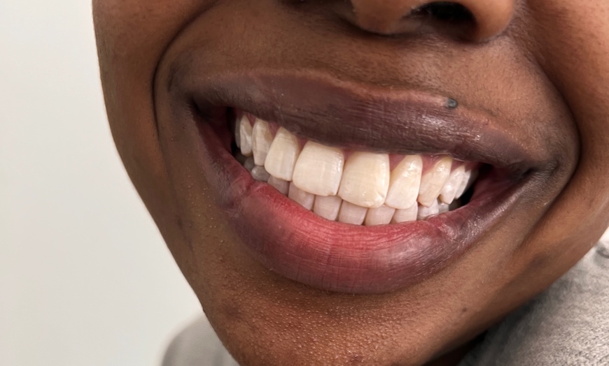 Image 1: 60 Minute Laser Teeth Whitening: Brighter Smiles w/ Personalised Care!