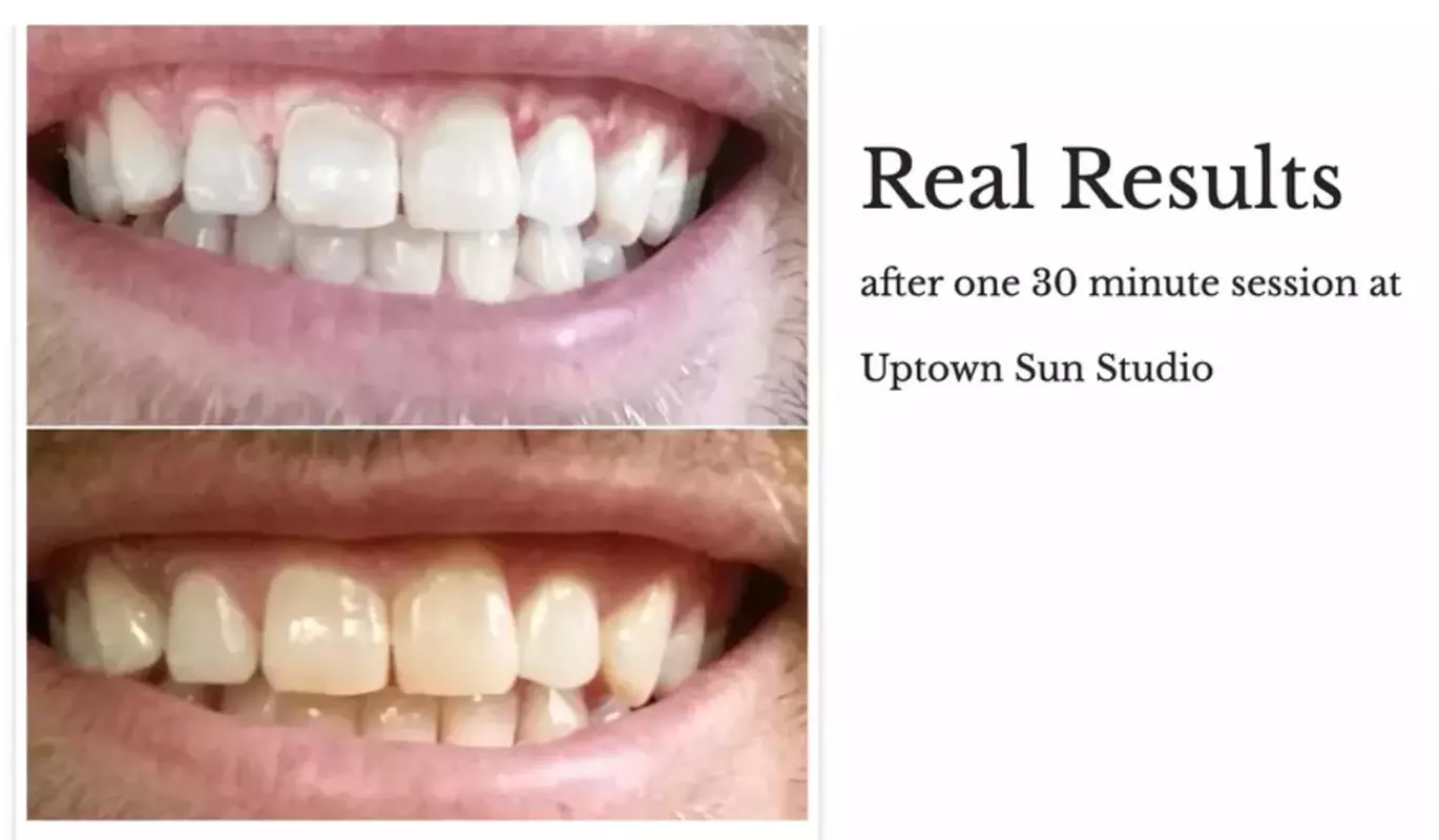 Achieve a Radiant Smile with LED Teeth Whitening at Sun Studio Tan, choose from various sessions, up to 46% off - Second Medium