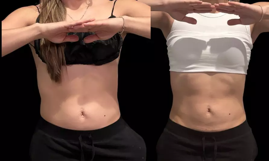 Up to 53% Off on Fat Reduction - Non-Branded at Southern Shapez