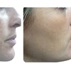 Image 7: Laser Skin Rejuvenation for Face, Neck, or Hands