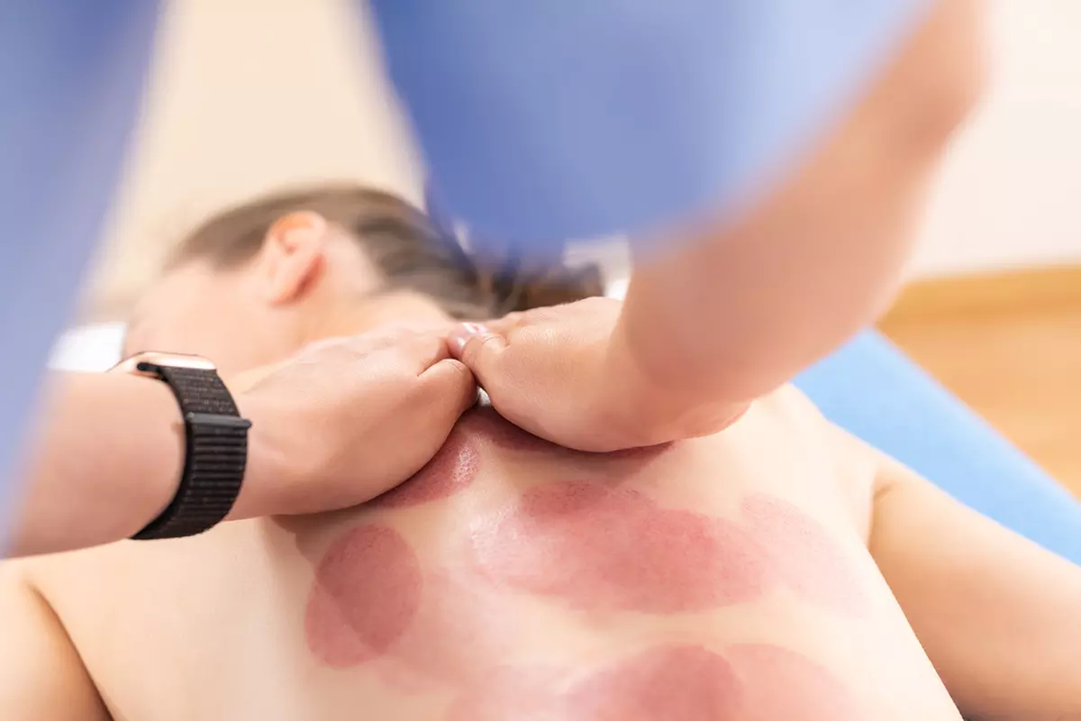 Three Cupping Therapy Sessions at Integrated Physical Medicine – Roselle (Up to 51% Off) - Primary Image