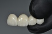 Up to 91% Off on Dental Implant / Corona / Veneer at ImplantWIDE Skokie - Second Medium