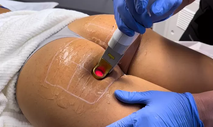 Up to 65% Off on Laser Hair Removal at NovaPiel Med Spa