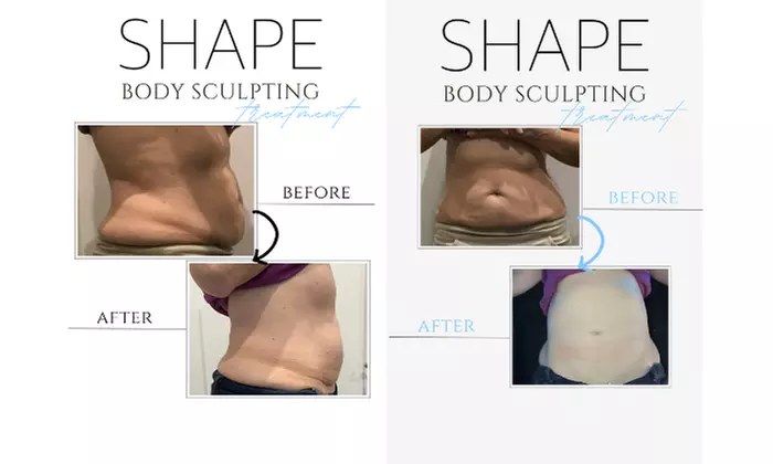 Get $1000 Off 10 Body Sculpting Treatments Package Now