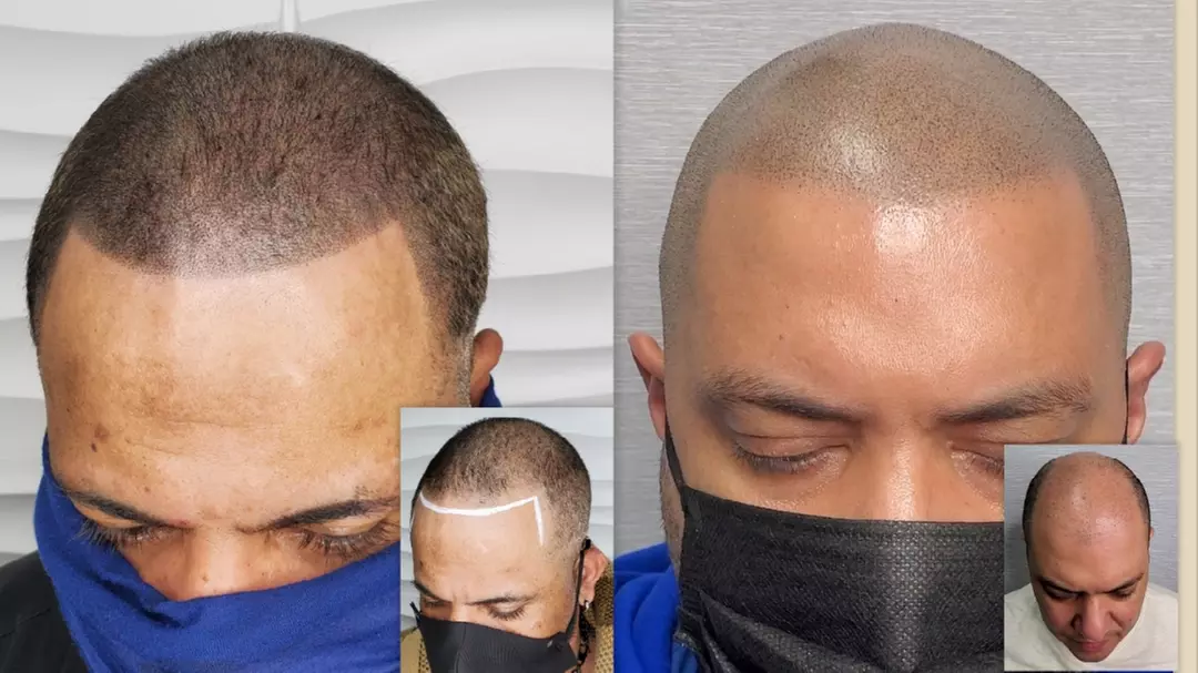 Up to 20% Off on Hair Restoration - Non-Surgical at Top Micro Ink - Primary Image