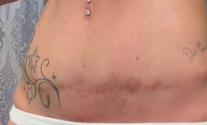 Image 7: Inkless Paramedical Tattoo for Stretch Marks and Scars