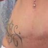 Image 7: Inkless Paramedical Tattoo for Stretch Marks and Scars