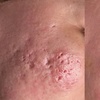 Image 2: One, Two, or Three Sessions RF Microneedling + InMode Morpheus8 
