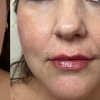 Image 4: Enhance your look with Vivara Med Spa's Revanesse Lip Filler and Versa+ Injections up to 33% off for a radiant appearance