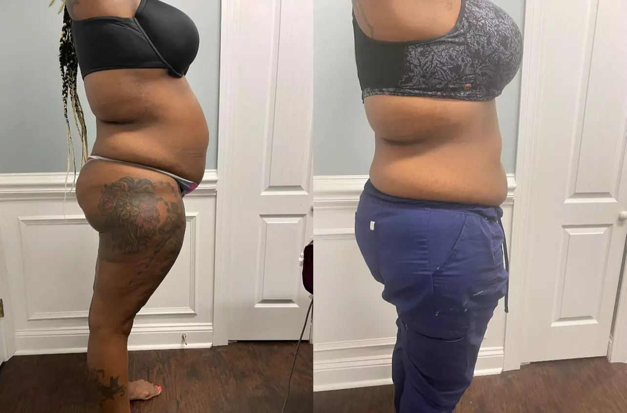 Up to 50% Off on Cavitation at Vividvesthetics skin&body