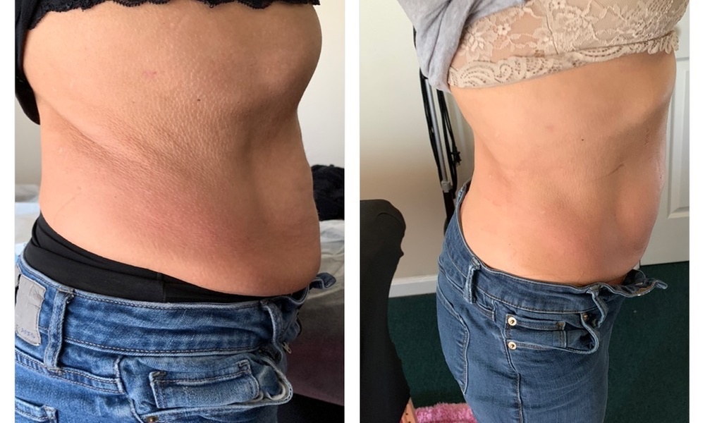 Explore non-invasive cavitation, laser lipo, and vitamin IV hydration