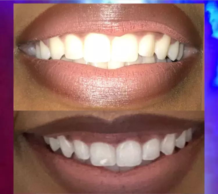 Experience Bright Smiles with Teeth Whitening at Camp Sacramento Aesthetics, Choose from 1 to 3 Treatments Up to 50% Off - Primary Image
