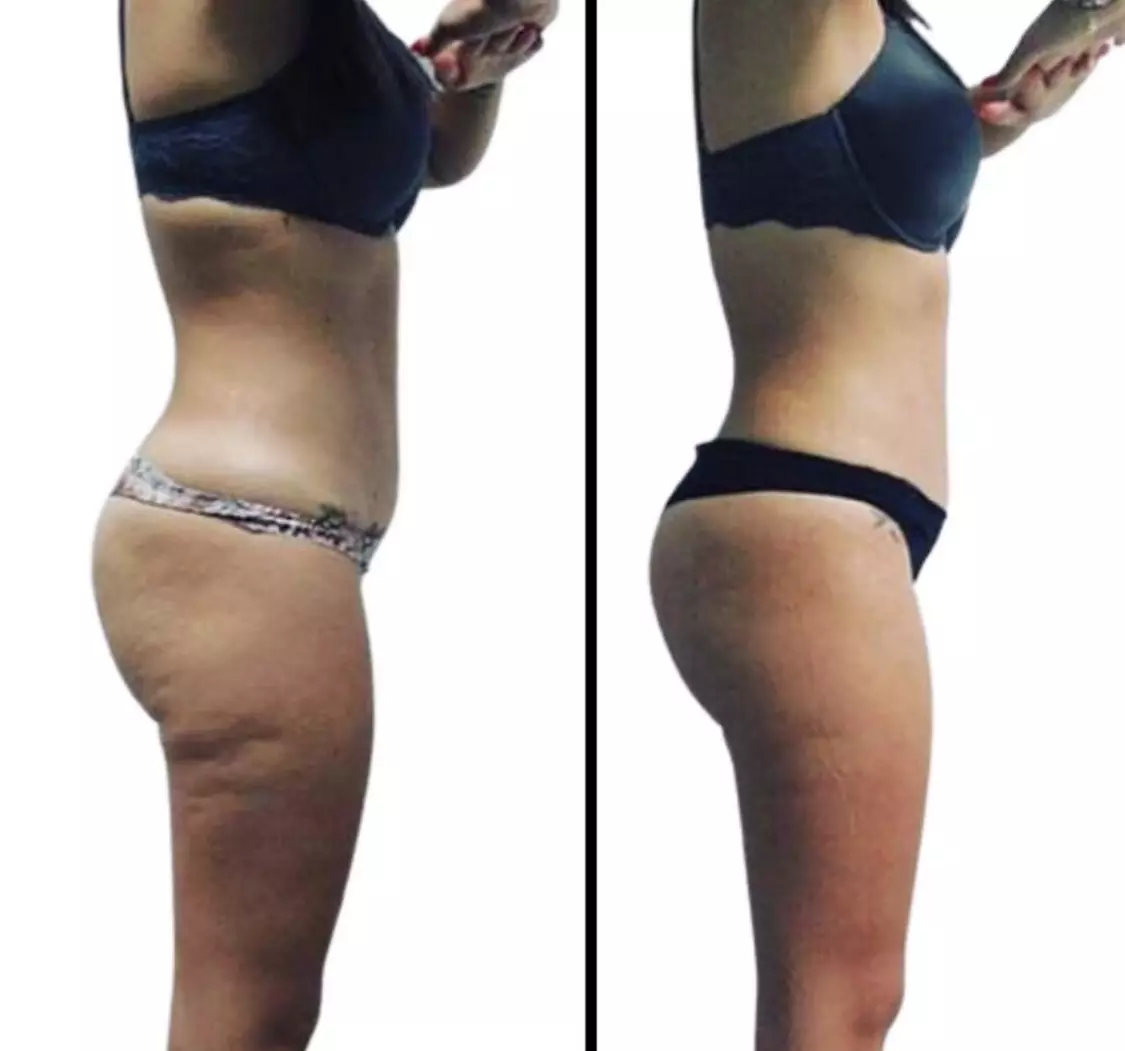 Up to 60% Off on EmShape body contouring and fat toning - Primary Image