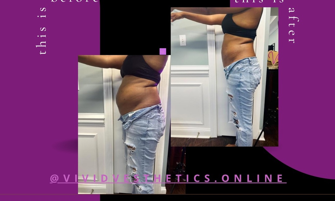 Up to 50% Off on Ultrasonic Fat Reduction at Vividvesthetics skin&body