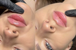 Up to 50% Off on Lip Enhancement at DermalBody Skin & Laser - Second Medium