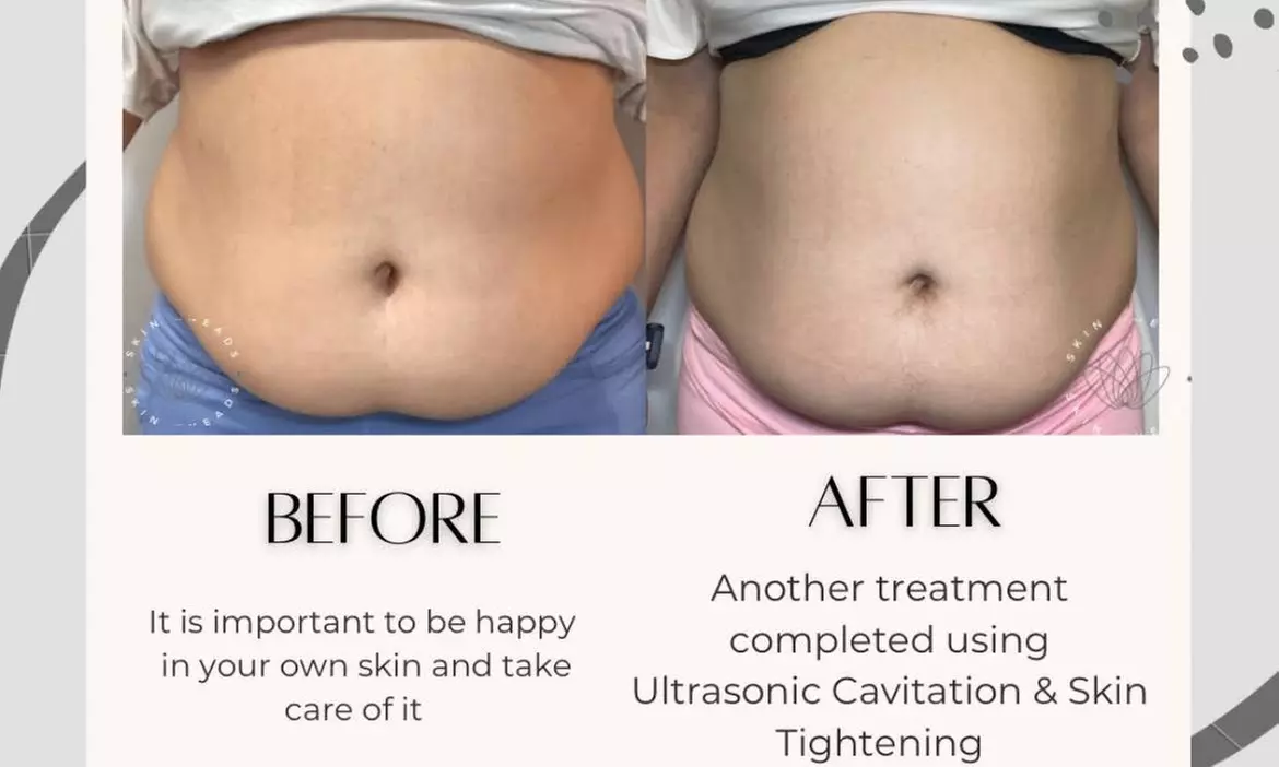 Up to 58% Off on Ultrasonic Fat Reduction at Skin Kneads - Primary Image