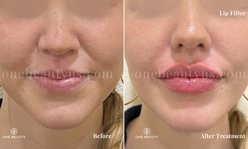 Image 2: Up to 50% Off on Injection - Voluma at One Beauty Aesthetics - Irvine