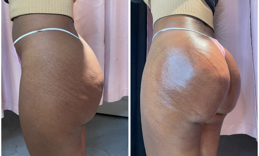 Image 3: Lift and tone with nonsurgical butt cupping sessions