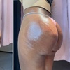 Image 3: Lift and tone with nonsurgical butt cupping sessions