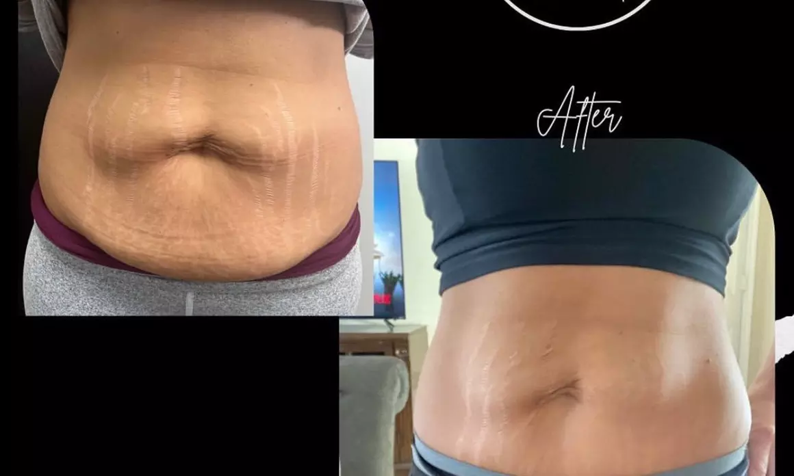 Up to 20% Off on Fat Reduction - Non-Branded at Reverse med spa - Second Medium