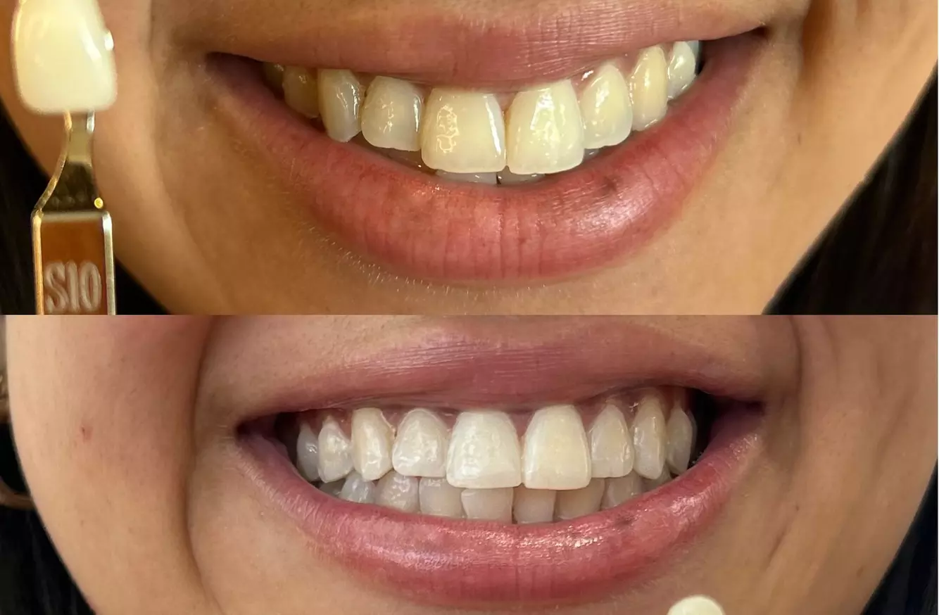 Up to 33% Off on Teeth Whitening at NKD SKN - Primary Image