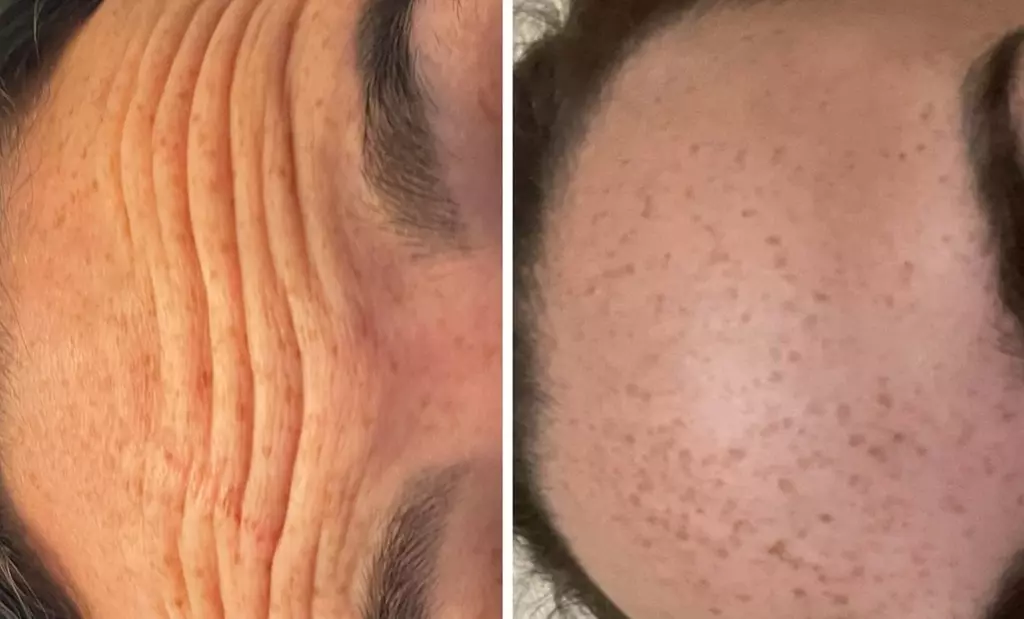 Unleash Your Glow: Transform Wrinkles with Dysport Magic!