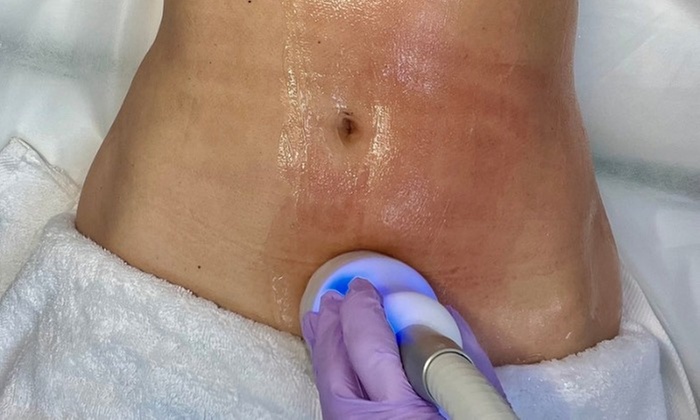 Experience Cryotherapy Sessions Fat Freeze Slimming Session!
