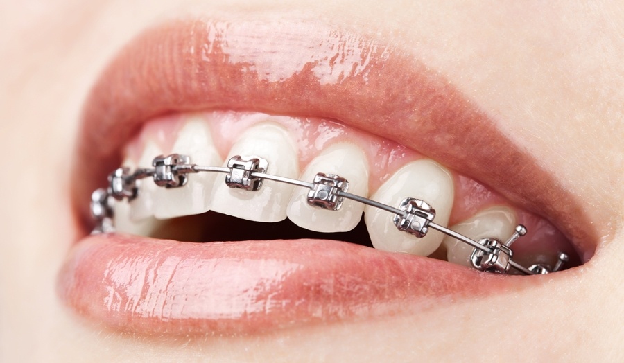 Image 1: Orthodontic Metal Braces Upper & Lower Teeth 