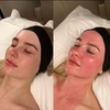 Image 5: Up to 60% Off Laser Skin Resurfacing at SlimmThicc Aesthetics