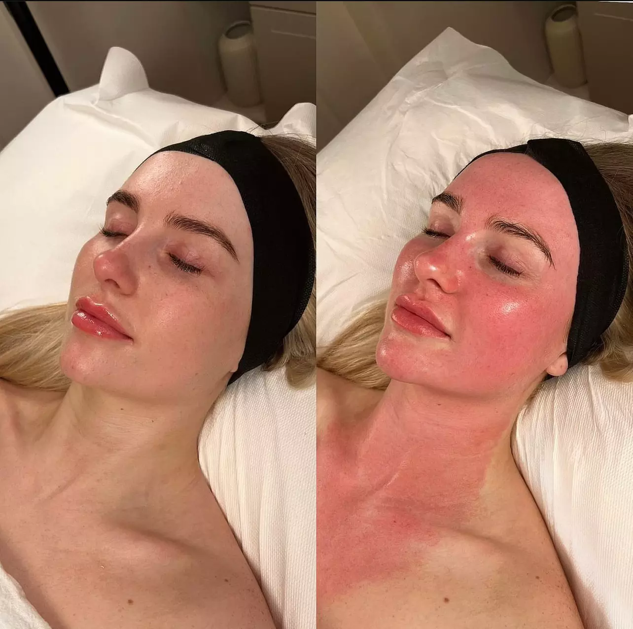 Laser Skin Resurfacing (Lutronic Hollywood Carbon Laser Peel) at SlimmThicc Aesthetics Spa (Up to 60% Off) - Second Medium