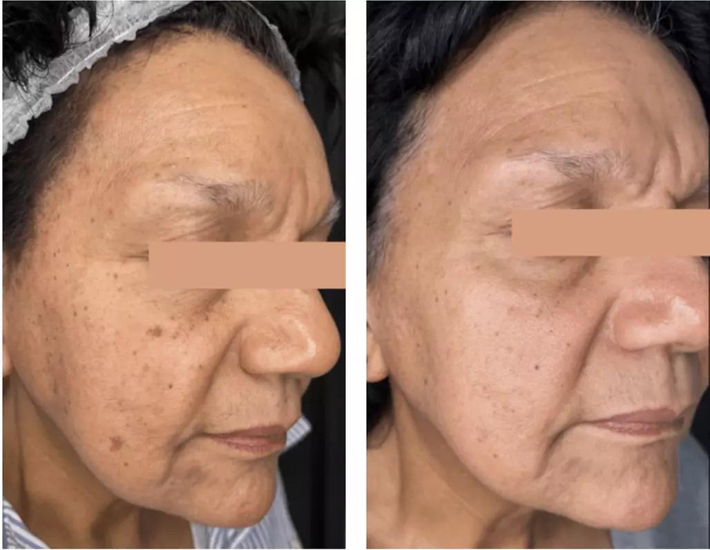 Up to 50% Off on Laser Skin Resurfacing at HealthZen Wellness Center and MedSpa - Primary Image