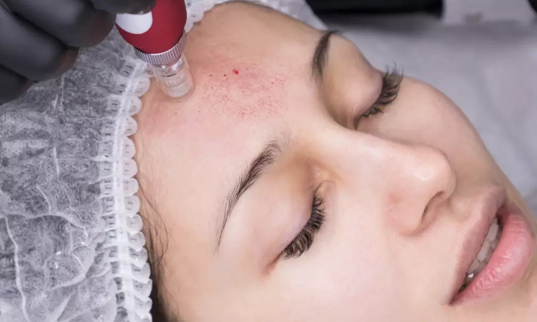Up to 56% Off on Micro-Needling at Nova Ink - Primary Image