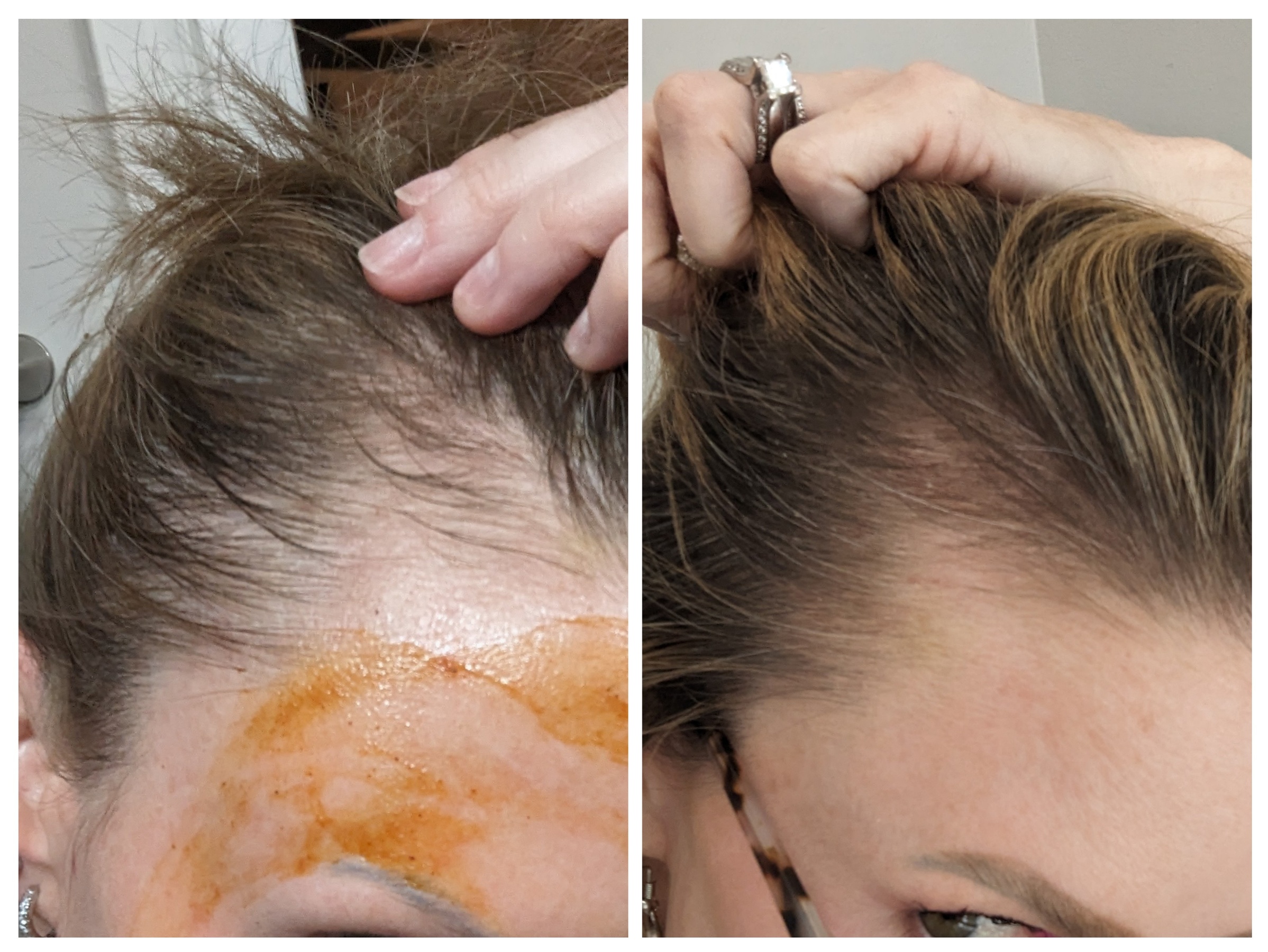 Boost Your Confidence With Innovative PRP Therapy