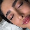 Image 2: Up to 30% Off on Injection - Dermal Filler at The Glam House Clinic
