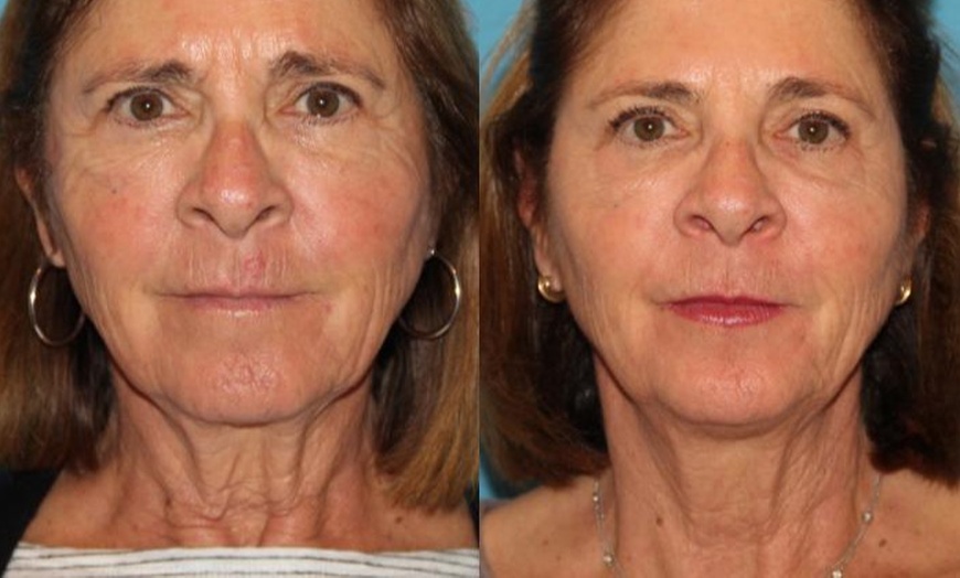 Image 6: Morpheus 8 Face and Neck / Abdomen or Butt Treatment at No Pain All Gain Spa (Up to 37% Off)