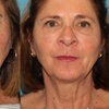 Image 6: Morpheus 8 Face and Neck / Abdomen or Butt Treatment at No Pain All Gain Spa (Up to 37% Off)