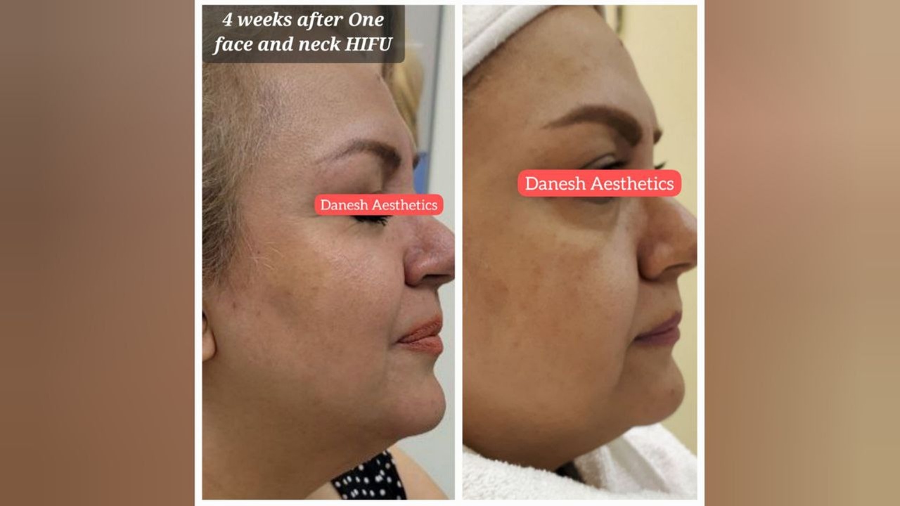 Up to 72% Off on  at Danesh Aesthetics