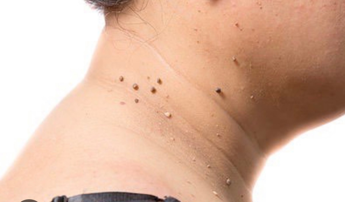 Effective Removal of Skin Tags and Cherry Angiomas
