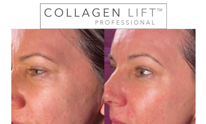 Image 2: Radio Frequency Skin Tightening at 51 St Giles Street Retreat