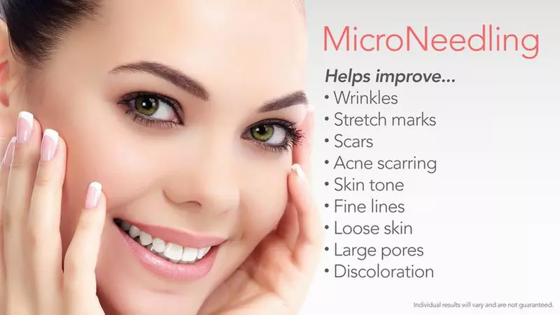Up to 65% Off on Micro-Needling at Nadia