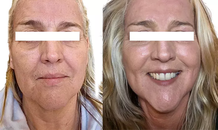 Up to 54% Off on Facelift - Non-Surgical at 11 - 11 Beauty Studio
