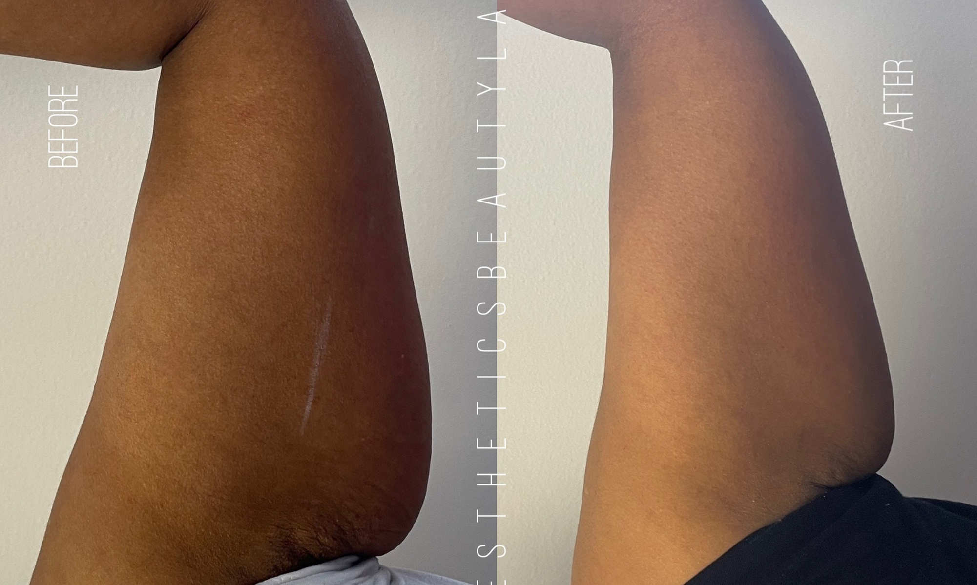 Up to 84% Off on Lipo - Non-Invasive Laser-iLipo at Aesthetics Beauty Laser
