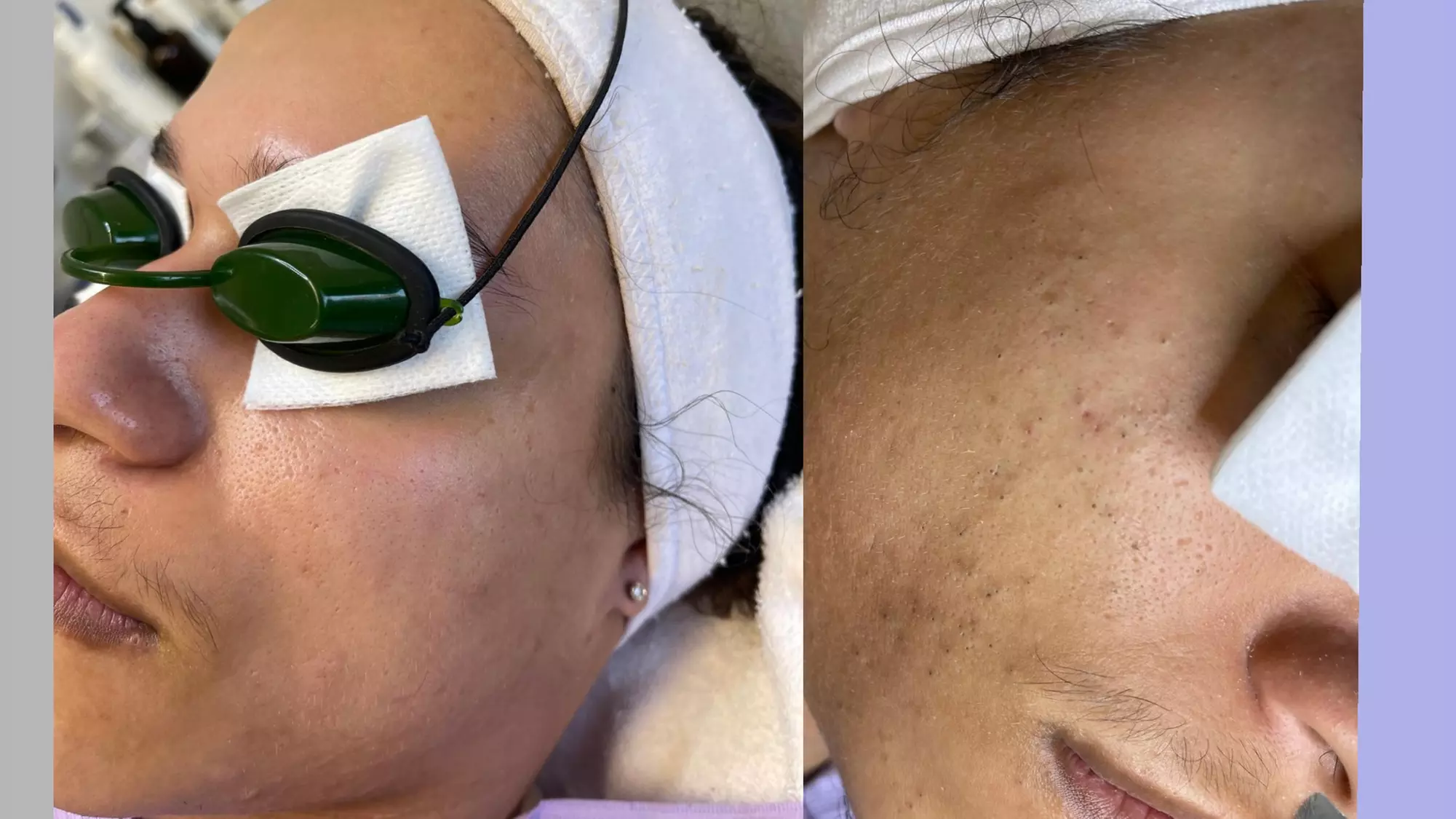 Up to 19% Off on Acne Treatment at Karina Skin Facials - Second Medium