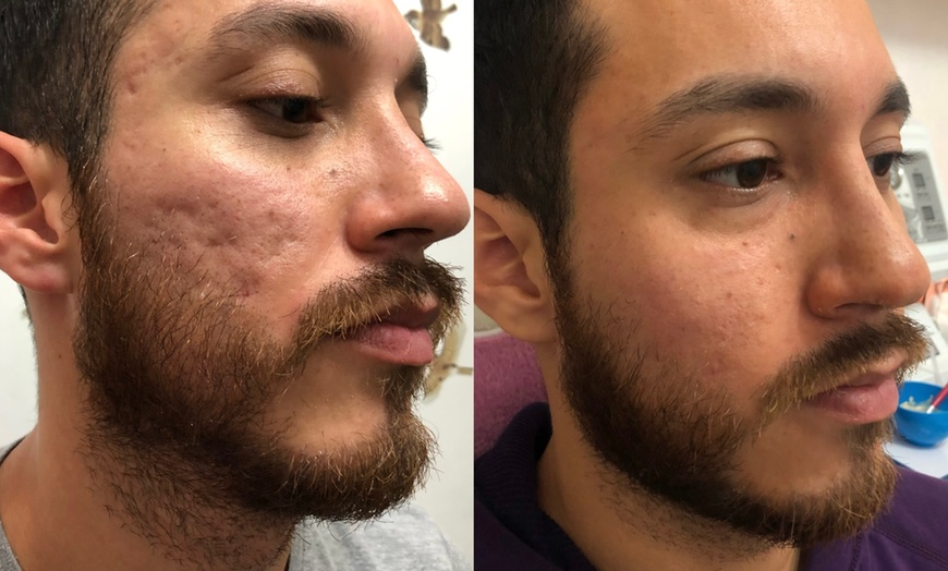 Image 4: Revitalize with 1 or 3 Non-Surgical Facelift and Anti-Aging Treatment