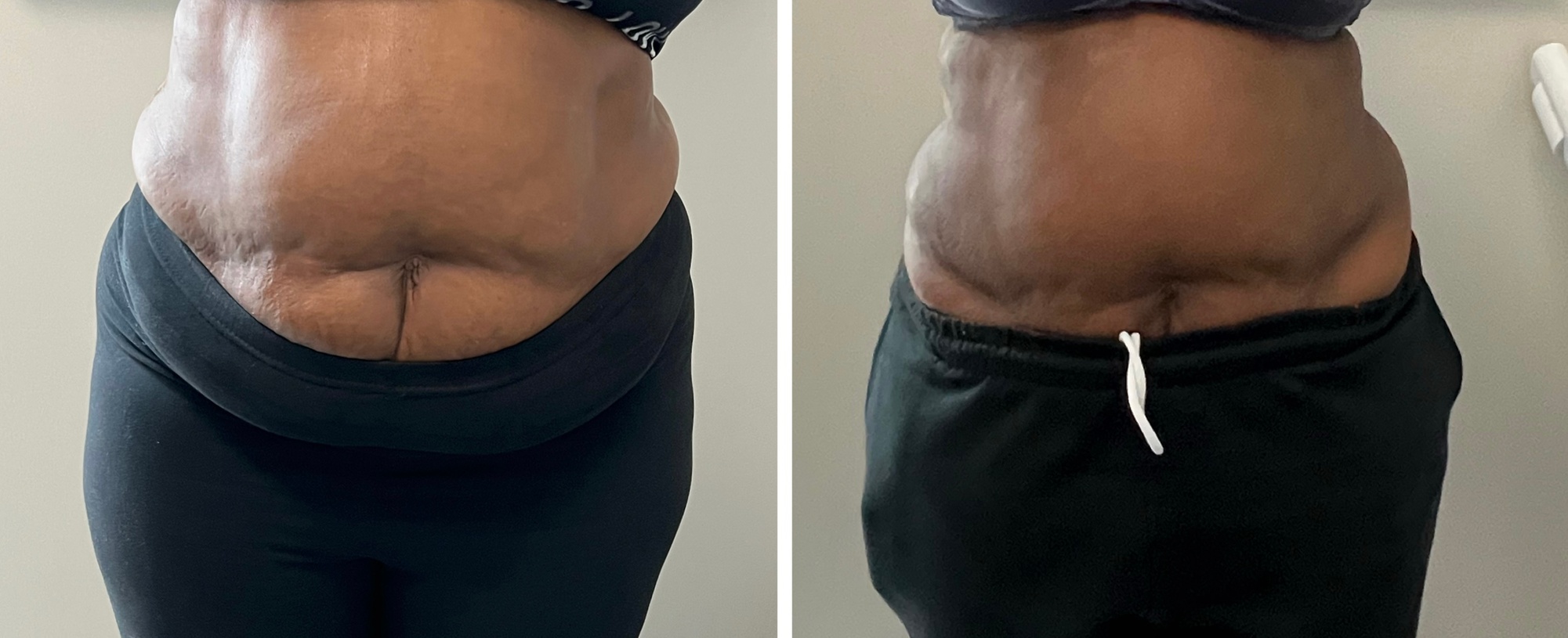 Up to 45% Off on Ultrasonic Fat Reduction