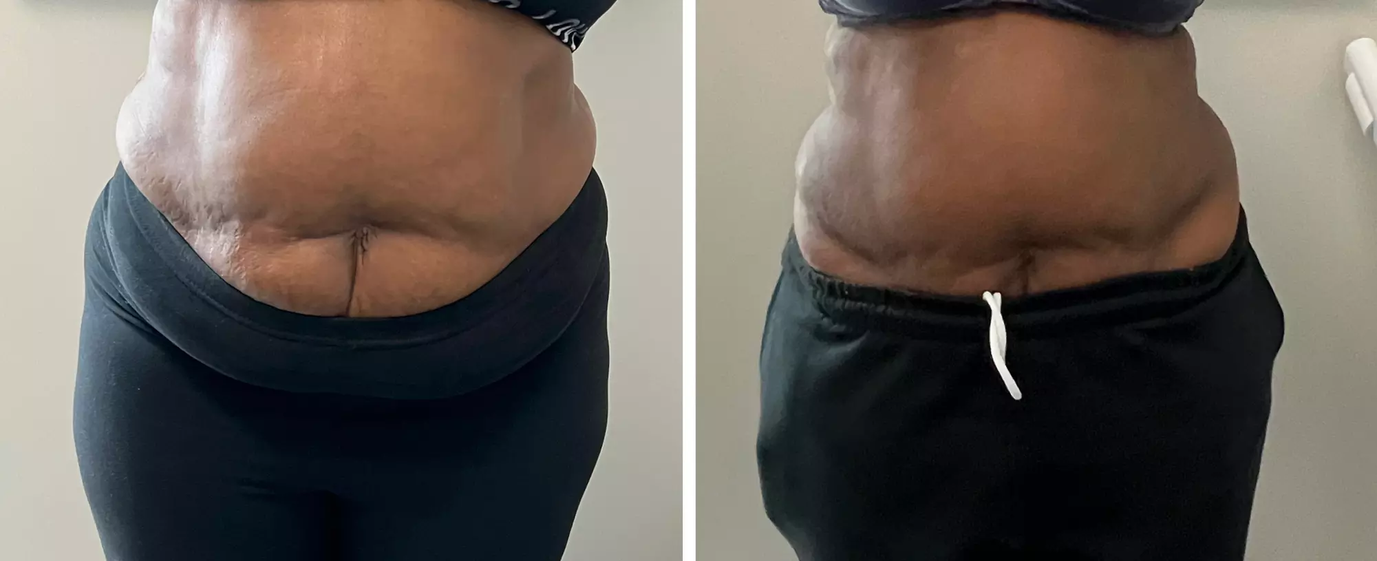 Up to 39% Off on Ultrasonic Fat Reduction at Glamorous brows and skin - Primary Image