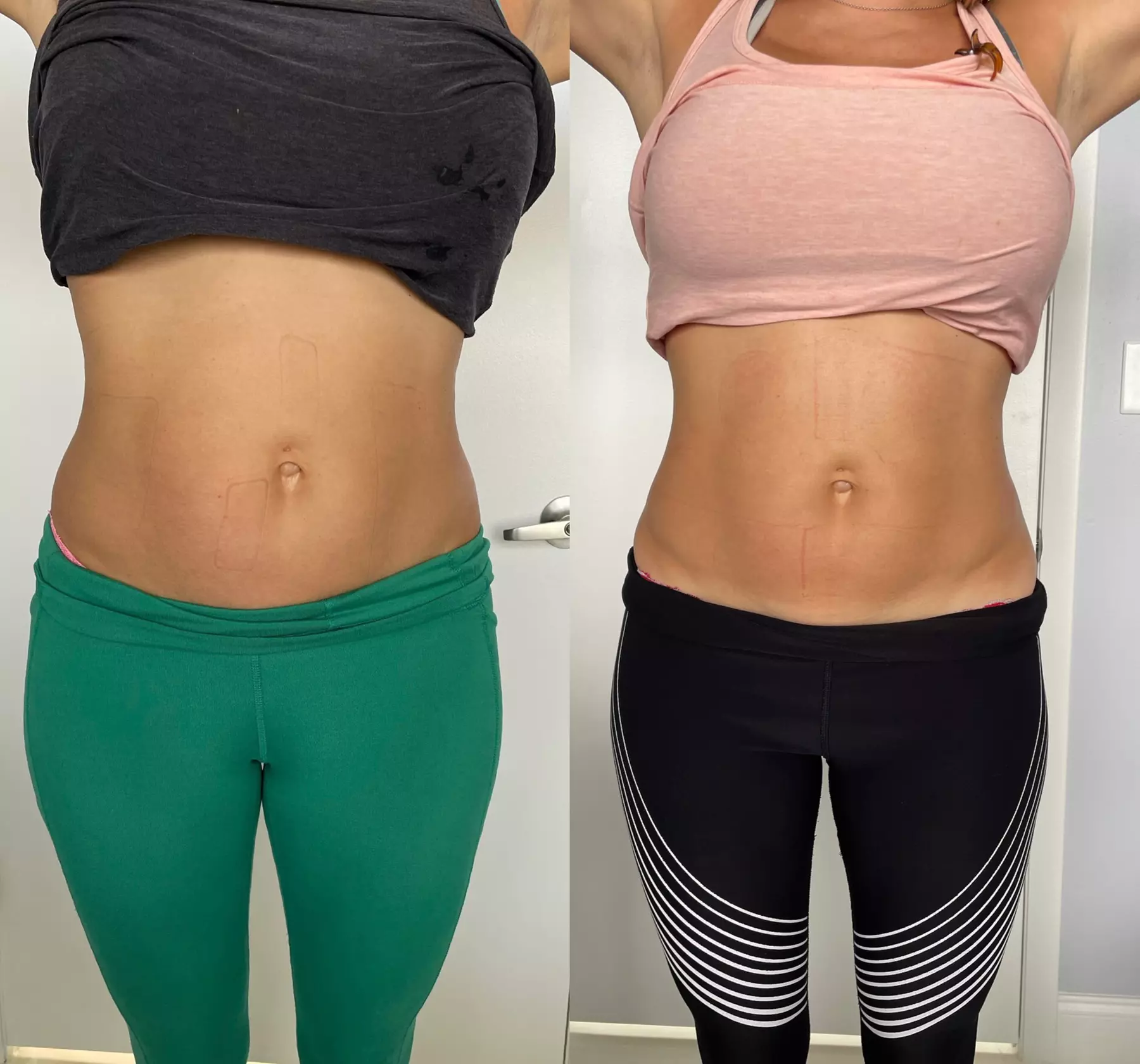 Zap Your Way to Fitness: Unleash the Power of EMS Today!